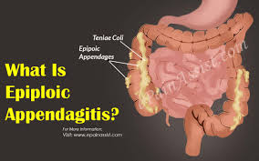 Epiploic Appendagitis - Hình ảnh minh họa